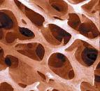 Un moderato sovrappeso offre protezione contro l'osteoporosi